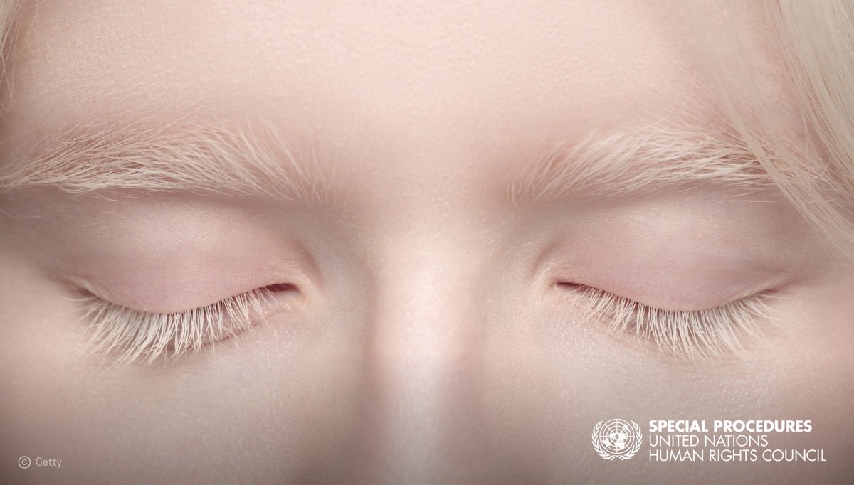 UN_SPExperts's tweet image. Skin cancer is one of the leading causes of death among persons with #albinism.  UN expert @UnAlbinism calls for urgent global action to protect the albinism community globally.
 
ohchr.org/en/press-relea…