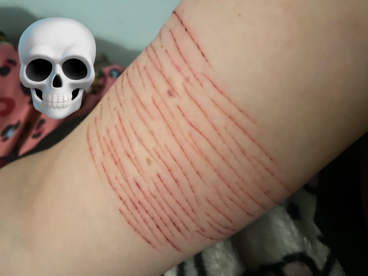 Vamp_9i's tweet photo. I cut the inner part of my upper arm and added more they aren’t that deep but it’s whatever just hope they scar lmao 😭 
#shtwt https://t.co/VJqZSlP58V