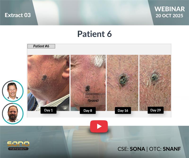 SonaNanotech's tweet image. Rodney’s melanoma lesion nearly disappeared by day 28 after two THT treatments, with no significant pain or side effects. Watch this remarkable patient response from Sona’s first-in-human study.
🎥 bit.ly/4qx6Zkx
#CancerResearch #Nanotech #Biotech $SONA