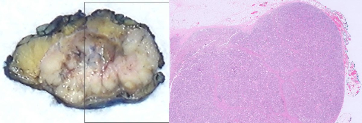 slusagar's tweet image. adult M with single adrenal mass, adrenalectomy:

🤔having trouble classifying this oncocytic adrenal neoplasm?

🔑that's b/c it's #endopath⏩#GUpath‼️

🔬Dx: metastatic prostatic adenocarcinoma
(patient had h/o GG5 PCA)