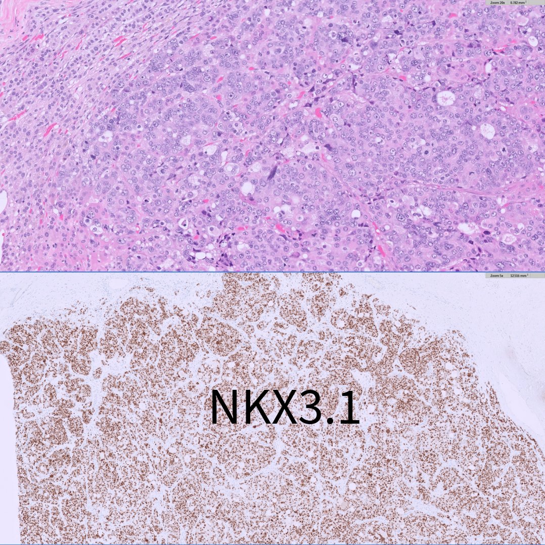 slusagar's tweet image. adult M with single adrenal mass, adrenalectomy:

🤔having trouble classifying this oncocytic adrenal neoplasm?

🔑that's b/c it's #endopath⏩#GUpath‼️

🔬Dx: metastatic prostatic adenocarcinoma
(patient had h/o GG5 PCA)