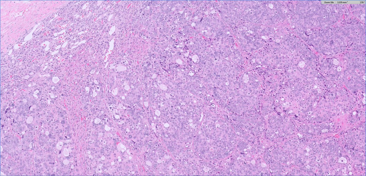 slusagar's tweet image. adult M with single adrenal mass, adrenalectomy:

🤔having trouble classifying this oncocytic adrenal neoplasm?

🔑that's b/c it's #endopath⏩#GUpath‼️

🔬Dx: metastatic prostatic adenocarcinoma
(patient had h/o GG5 PCA)