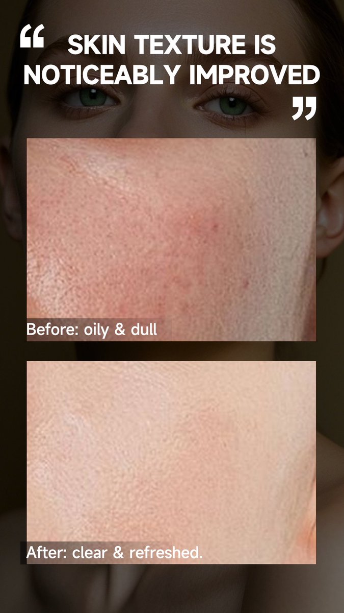 BacheriSkincare's tweet image. ✨ From Oily to Glowy: Your Fall Skin Reset

✅ #BeforeAfter #GlowingSkin #ClearComplexion #OilControl #BrighteningSerum #VitaminCSerum #Beauty #FallSkincare #HealthySkin #AmpouleSerum #AmazonBeauty #BeautyDeals #SkincareRoutine #Bacheri #AmazonBeauty #BeautyDeals