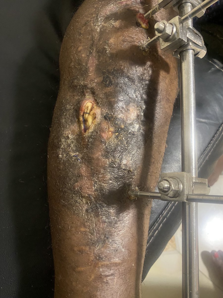 Marvelcukandu's tweet photo. @GunterFehlinger @POTUS It is as a result of high insecurity in Nigeria that I lost my mobility. Pray Nigeria never happens to you,  cos  being Nigerian has dealt with my life. Imagine returning from a trip only to be kidnapped a week after arrival. And still, no good healthcare system. Still on clutche https://t.co/FhvbemIxsz