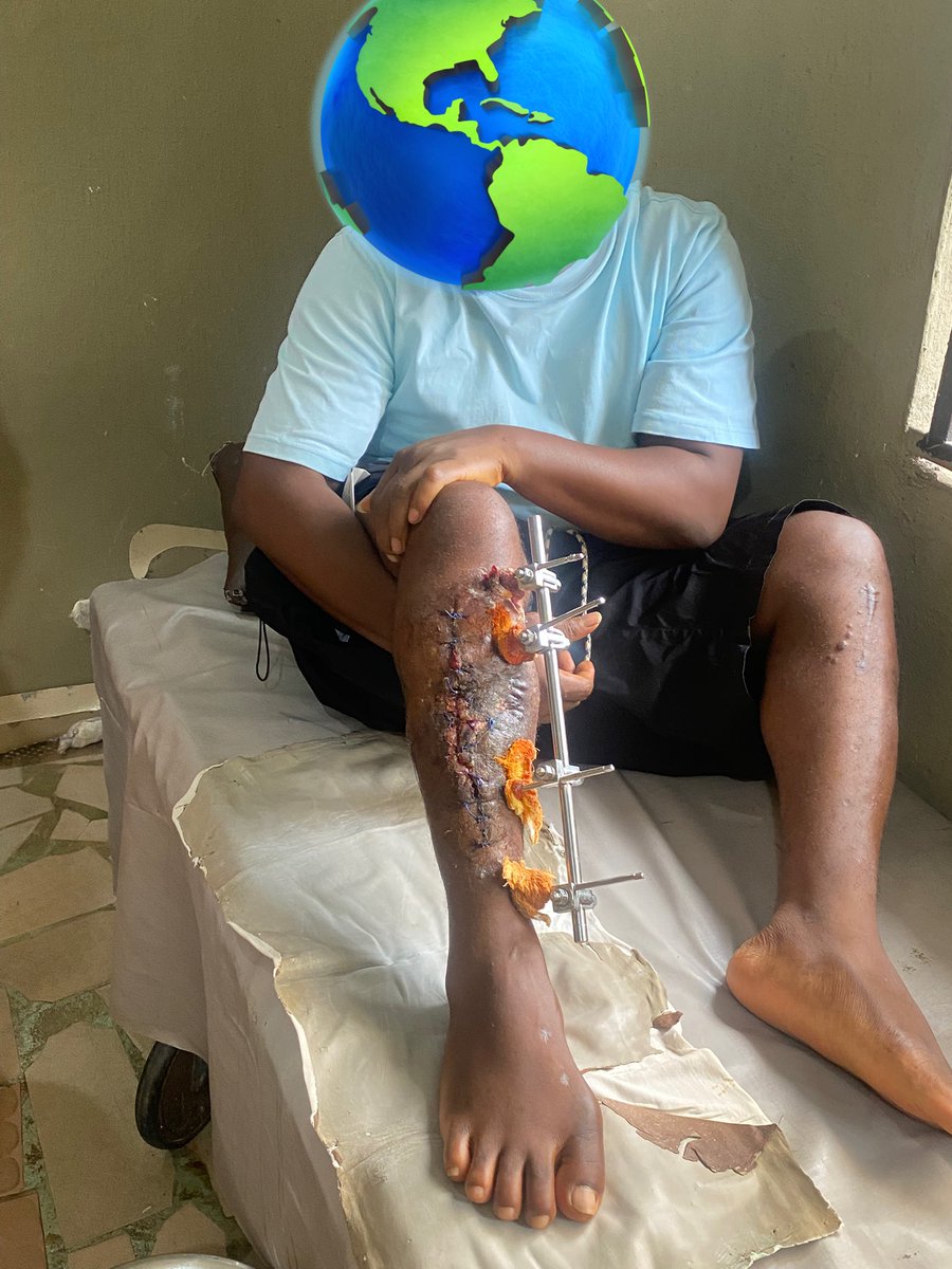 <a href="/GunterFehlinger/">Gunther Fehlinger-Jahn</a> <a href="/POTUS/">President Donald J. Trump</a> It is as a result of high insecurity in Nigeria that I lost my mobility. Pray Nigeria never happens to you,  cos  being Nigerian has dealt with my life. Imagine returning from a trip only to be kidnapped a week after arrival. And still, no good healthcare system. Still on clutche