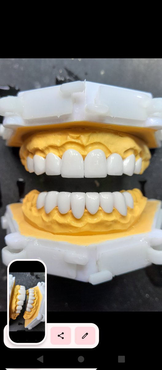 SunSmile_Lab's tweet image. #răng sứ thẩm mỹ 🥳