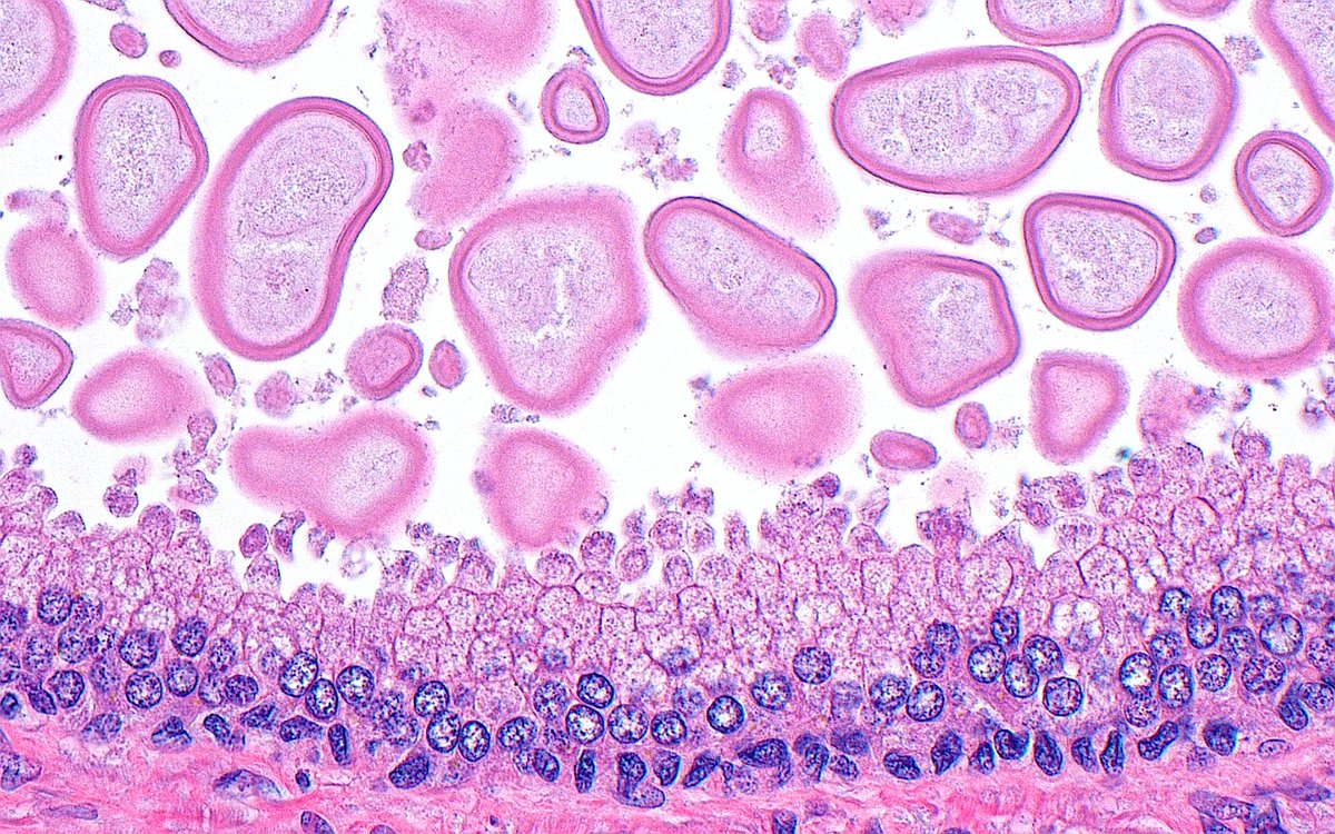 ziad_zaatari's tweet image. 🔬📸 &quot;Corpora Amylacea Rain&quot; 🌧️ ~ #GUpath #Pathology #PathArt