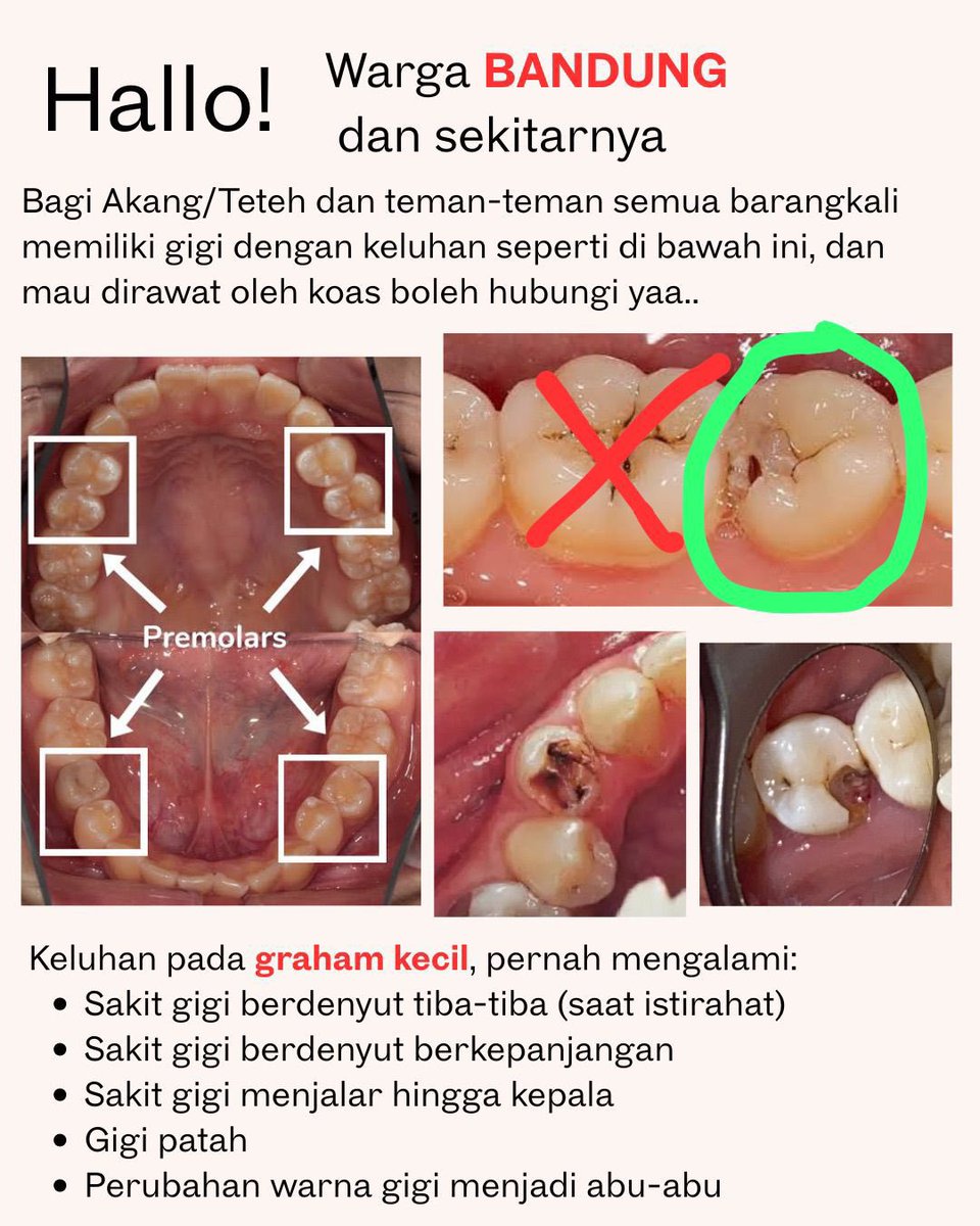 kokjunhe's tweet photo. apakah ada yang gigi graham kecilnya (premolar) berlubang besar, sakit dan berkenan dirawat Perawatan Saluran Akar di Kota Bandung? Biaya perawatan ditanggung oleh koas yg bersangkutan. Boleh open dm/rep yaa
#koasgigi #koasgigibandung #zonauang #PSA #tambalgigi #gratis #bantu https://t.co/hlBrUQHrA6