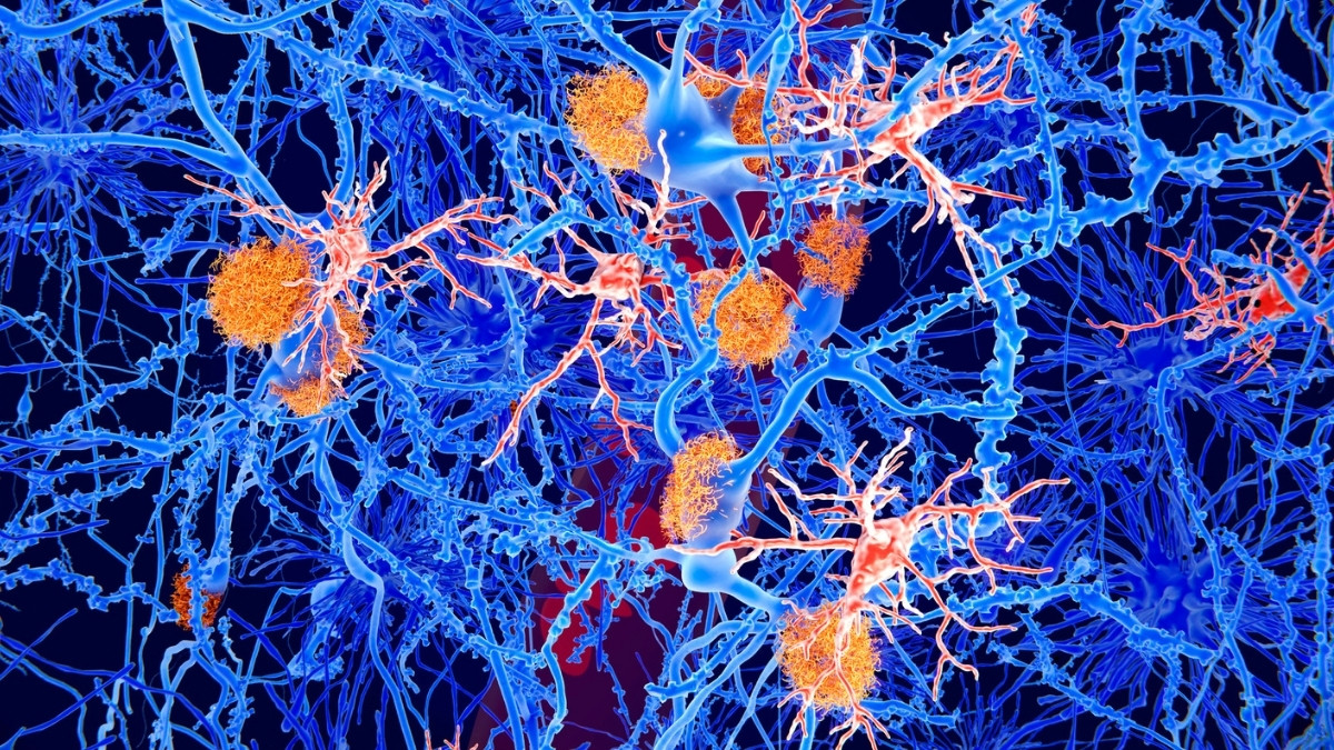 VictoriRegina11's tweet image. 'Young' Immune Cells Partly Reverse Alzheimer's Symptoms in Mice #sciencefather #researchawards #AlzheimersResearch #Neuroscience 

A groundbreaking study has shown that transplanting “young” immune cells into mice with Alzheimer’s disease can partially reverse symptoms.