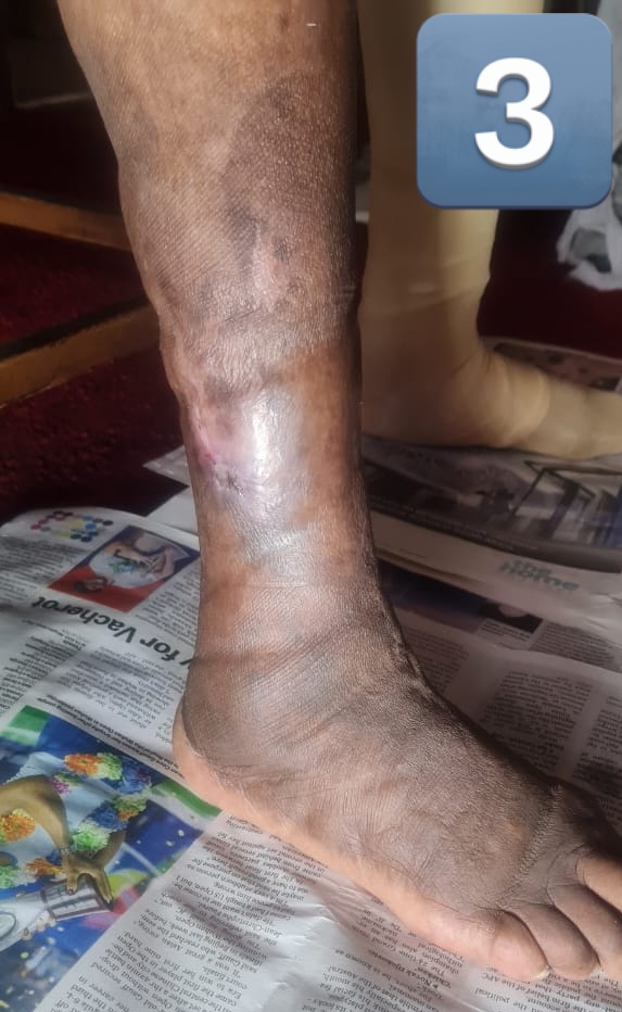 Qokani's tweet photo. Diabetic and Hypertensive 82 years old Female just escaped amputation. she is happy the family is happy and I am more than happy and thankful to God for these herbs and wisdom.  

1. Before Godly Herbs 
2 &amp; 3 On the treatment 

Herbalism is Godly. 🍃💚😉 https://t.co/FwPXArTW8J