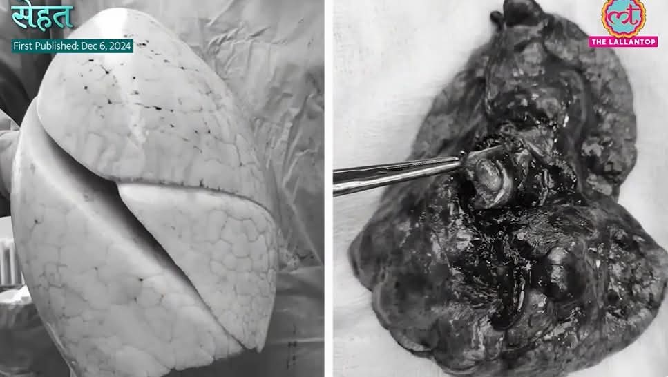 ये तस्वीर डॉक्टर कामरान अली ने शेयर की है जो इंसान के फेफड़ों की है। तस्वीर देखकर आपको लग रहा होगा कि पहली तस्वीर सिगरेट नहीं पीने वाले इंसान का फेफड़ा है और दूसरा बहुत ज्यादा सिगरेट पीने वाले इंसान का फेफड़ा होगा...अगर आप ऐसा सोच रहे हैं तो आप गलत सोच रहे हैं।
ये दोनों फेफड़े