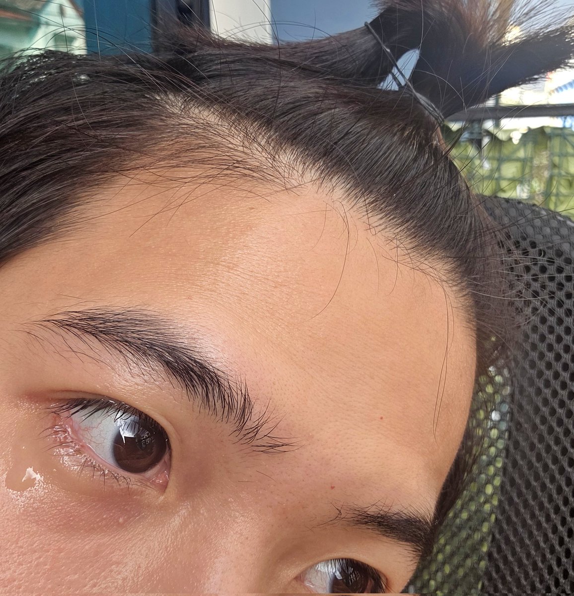 rathavit1997's tweet image. ตุ่มที่หลายคนเป็นห่วง ตอนนี้มันจากไปแล้วนะครับบบ อยู่บ้านยาวๆไป 7 วันน ~ 
เช็คแผลอีกทีอาทิตย์หน้าาาา 🫶