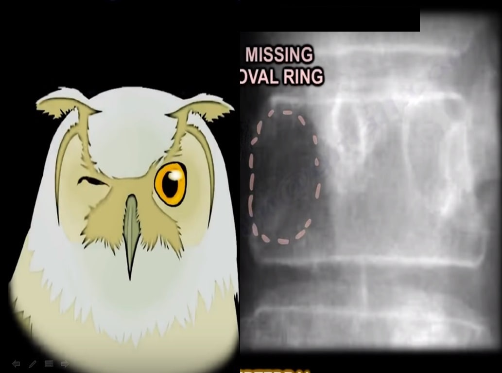 IhabFathiSulima's tweet image. Winiking owl sign is seen in 

A.Vertebral Tuberculosis
B. Vertebral metastasis
C. Vertebral fracture due to cervical traction
D. Verteral mass