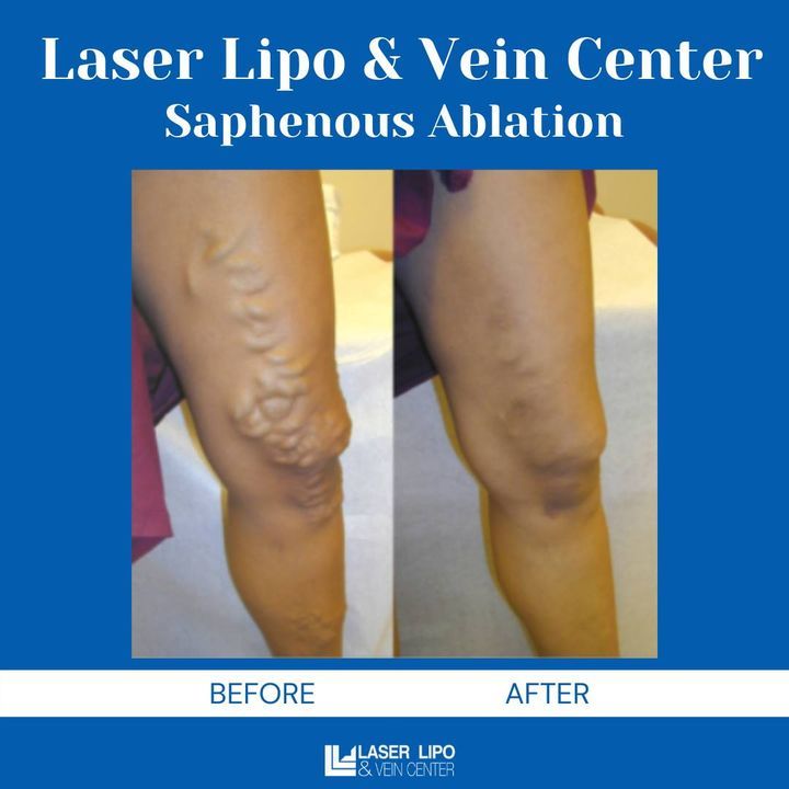 LaserVein's tweet image. Wave goodbye to painful veins and welcome smooth, beautiful legs! 😍 Witness the incredible transformation with Saphenous Ablation. 
Call 636-614-1665 to schedule your appointment today! ✨

#VeinTreatment #LLVC