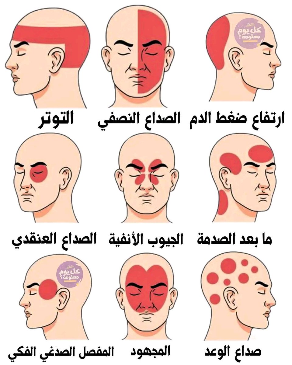 ✅️ صداع خلف الرأس: ارتفاع ضغط الدم
✅️ الصداع النصفي : بسبب اضطرابات الأعصاب
 ✅ الصداع في تلك المناطق :️ التوتر
✅️  الصداع في تلك المناطق :️ مابعد الصدمة
✅️ الصداع في تلك المناطق :️  الجيوب الأنفية 
✅️ الصداع العنقدي : العوامل الجينية او الوراثية
✅️ صداع الرعد :