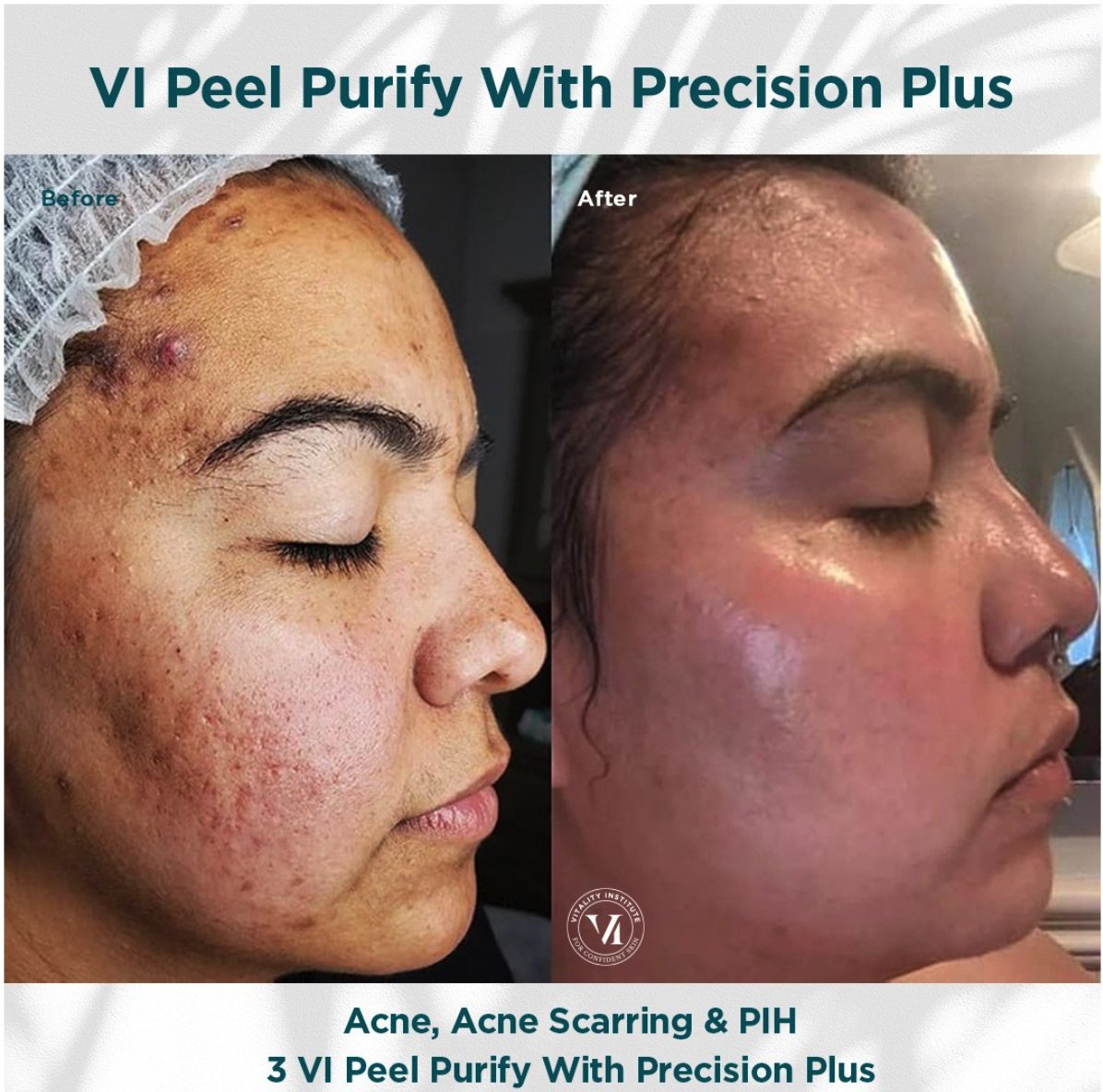 WomenFirstLA's tweet image. Peel away your old skin and refresh! Ask your doctor if the VI PEEL is right for YOU!! Women First, LLC is here to give your skin the treatment it deserves!