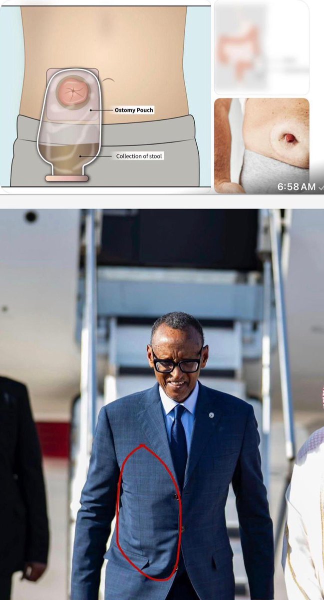 Les observateurs ont remarqué une bosse visible sous le costume du président Kagame.

Certains experts médicaux ont suggéré qu’il pourrait s’agir d’une poche de colostomie — je ne le confirme pas, mais si c’est vrai, cela soulève une préoccupation légitime <a href="/Mielngoma11/">MIEL🐝DU KONGO😋🍯🍯</a>