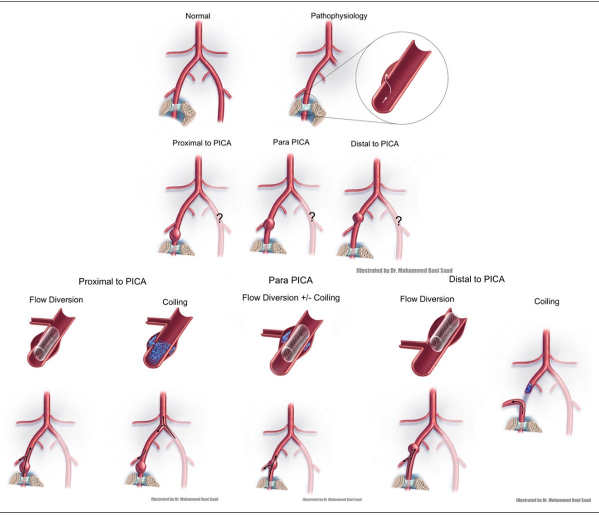Recent publications!
This publication based on team effort to help elucidate the best endovascular treatment strategies to tackle Intradural vertebral artery dissecting aneurysms.
It is done under the supervision of Dr Spiotta. 

Link: tinyurl.com/4dyt8mf3

#research #neuro