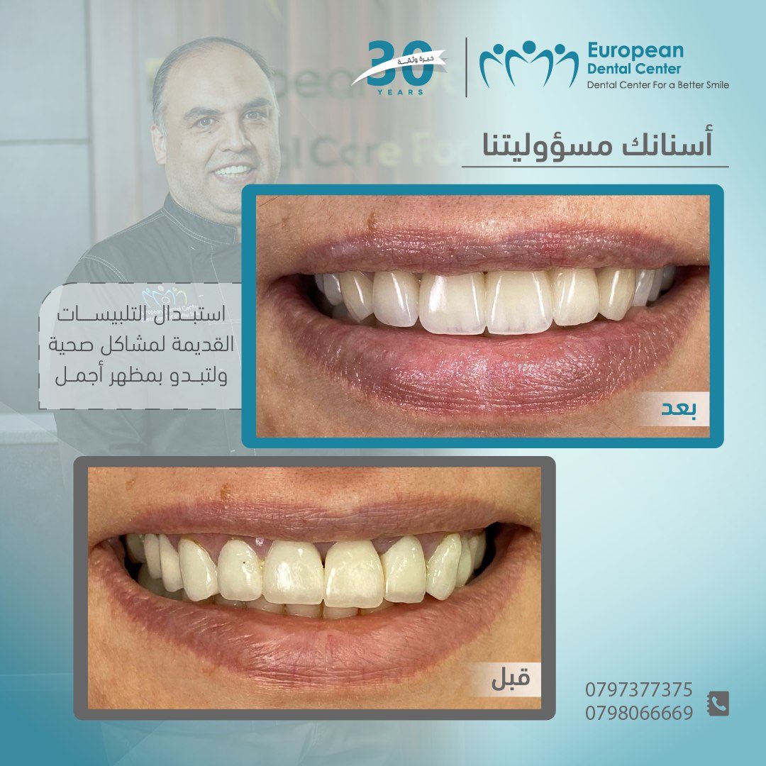 mohanadskiswani's tweet image. المركز الأوروبي لطب الأسنان 30 عامًا من الخبرة في زراعة وتجميل الأسنان متخصصين في الحالات الحرجة

حاصل على اعتمادية تيموس في الجودة والكفاءة المهنية والطبية لست سنوات على التوالي (2015-2021)

احجز موعد استشارتك الآن الموقع الإلكتروني Eurodentalcenter.com 
الهاتف📞: 0797377375…