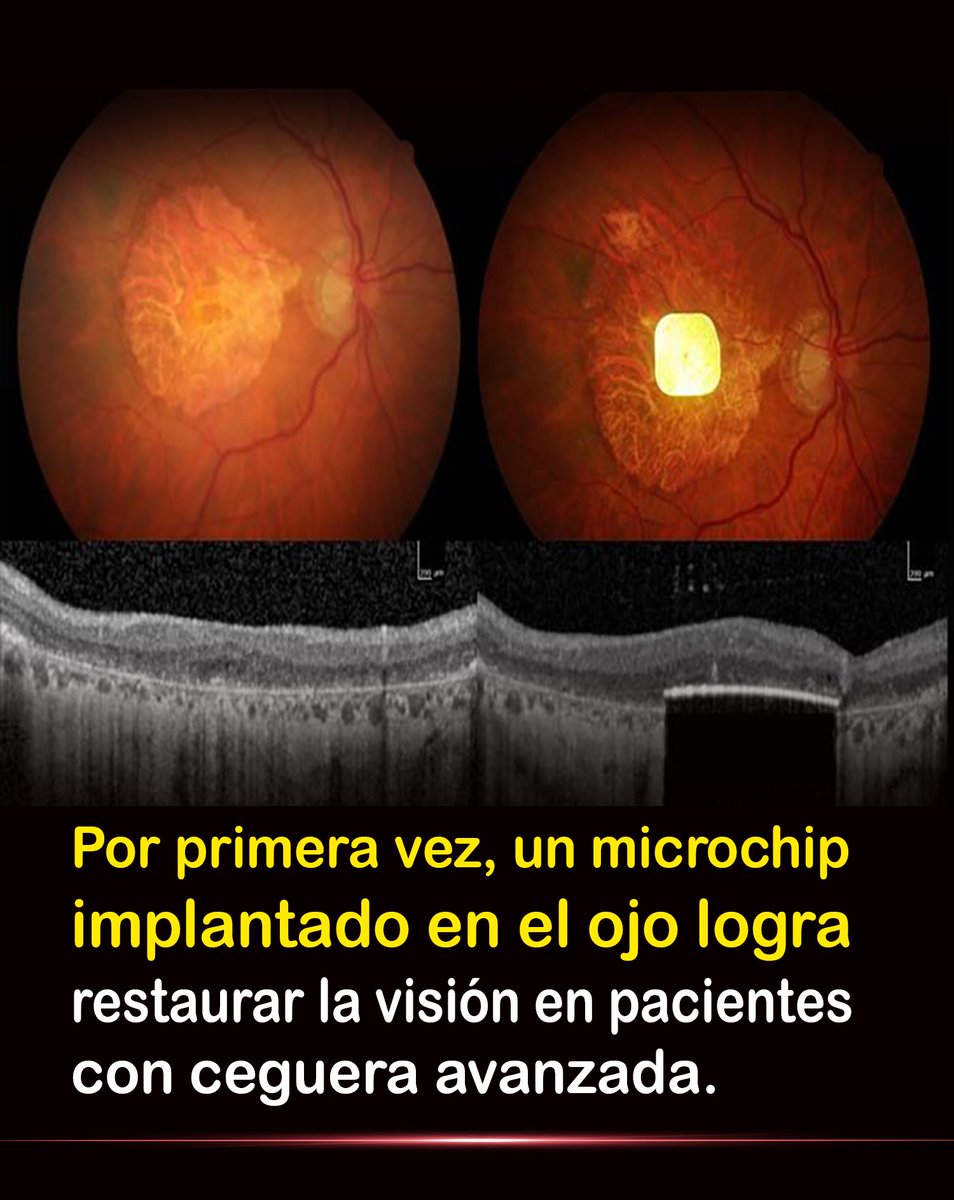 La medicina acaba de lograr lo que parecía imposible: devolver la vista a personas que habían perdido toda esperanza. Un microchip ocular está reescribiendo la historia de la visión humana. 👇

Mayor info: wp.me/p9eYmY-9kc