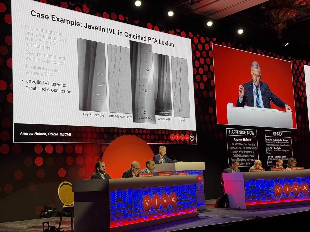 ShockwaveIVL's tweet photo. Thank you, Prof Andrew Holden, for presenting the latest #ForwardPAD IDE 12-month data at #VIVA25. This study shows that #ShockwaveJavelin delivers lasting durable benefits and low complication rates, enabling treatment for severely calcified, difficult to cross peripheral lesions.

Read the Press Release: https://t.co/zYD1k12T2e

Learn more about Shockwave Javelin: https://t.co/zLk2b9pLc9

US Rx only. ISI https://t.co/x46wohk9Gd @VIVAPhysicians