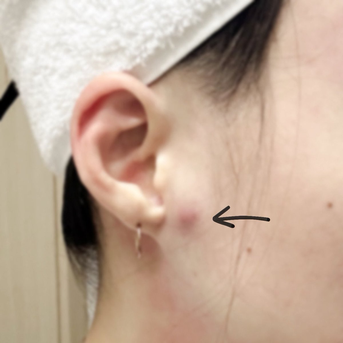 보기에 좀 그래서 블러 씌워서 옴..
이 거대 속드름이 트러블 패치+티트리오일+클리어틴으로 해결되는지 시험해보겠습니다