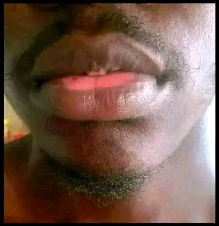 unsulliedwarior's tweet image. Doctors on my timeline, What is the main cause of this red mount disease? Help a friend