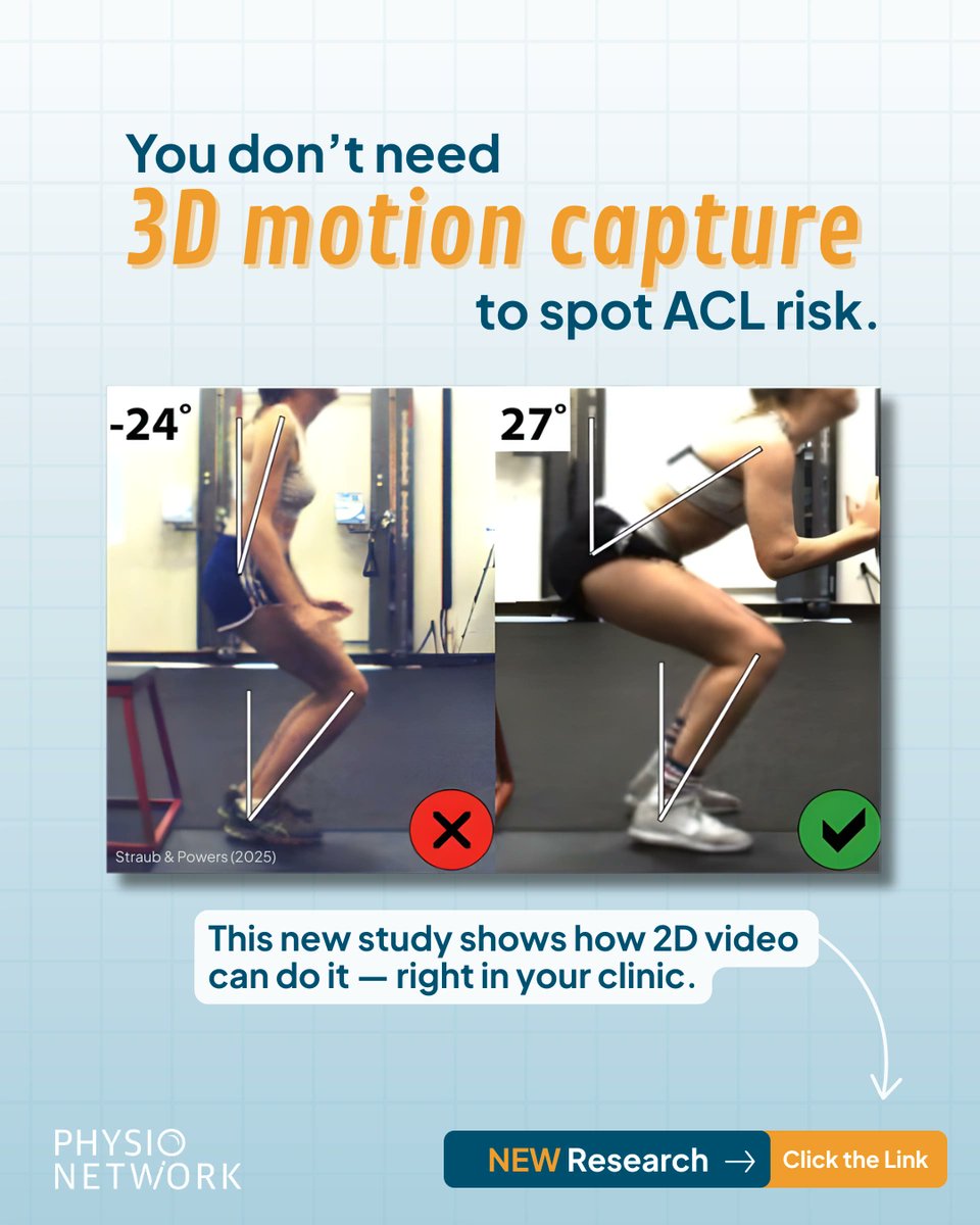 PhysioNetwork's tweet image. 🔮 Ever wished you could predict ACL injury risk without expensive lab tech?

A novel study shows how 2D analysis can accurately assess limb biomechanics &amp;amp; identify risk

👉 Tap the link to read our full breakdown now:

physio-network.com/research-revie… ⁠

----
Original Article: Straub…