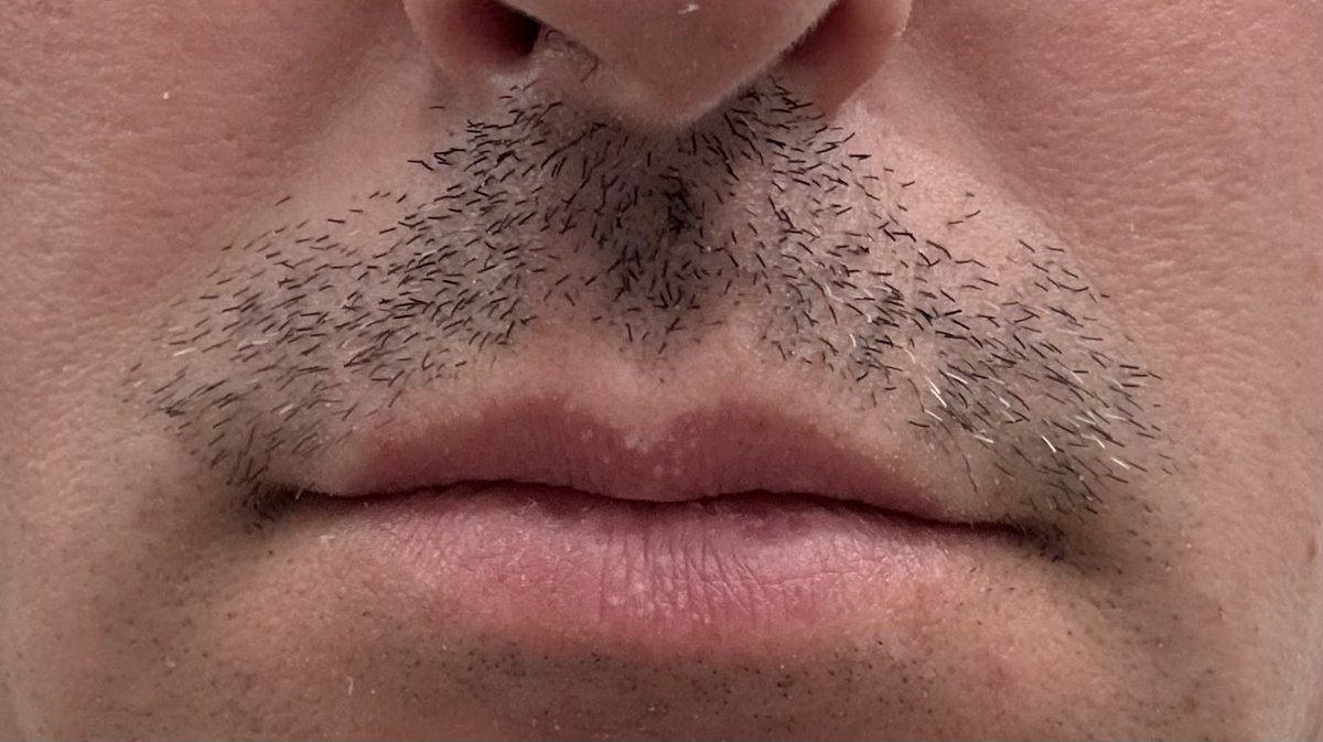 Day 5 of #NoShaveNovember