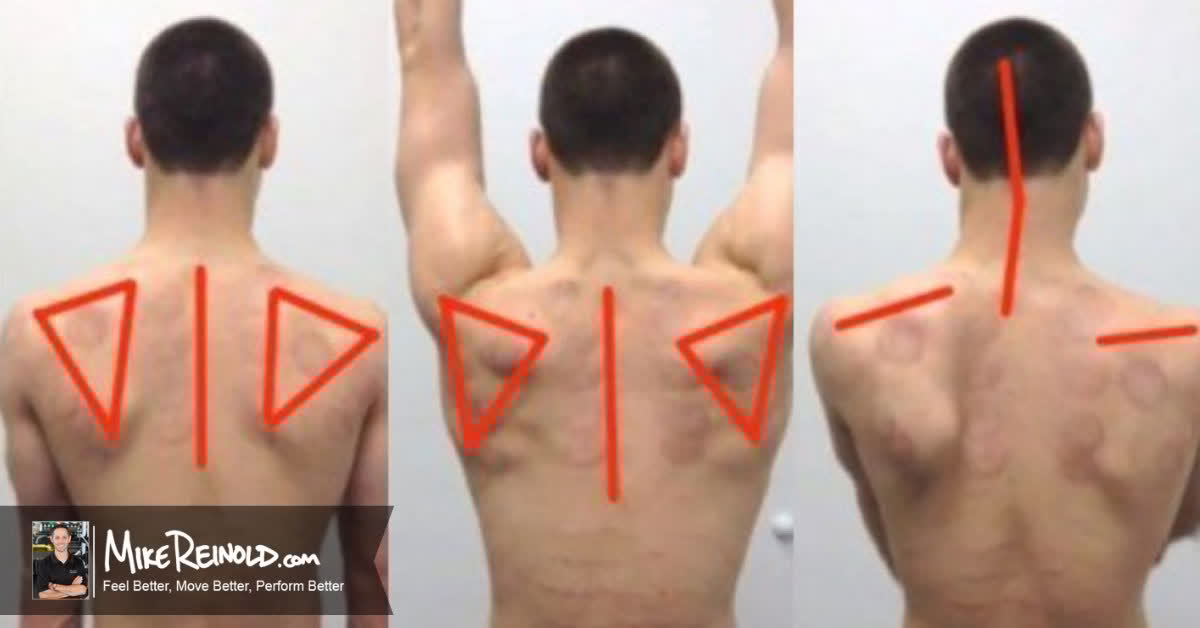 [Video] Can you see all the compensations during this assessment of overhead arm elevation? #SolvePT mikereinold.com/assessing-over…