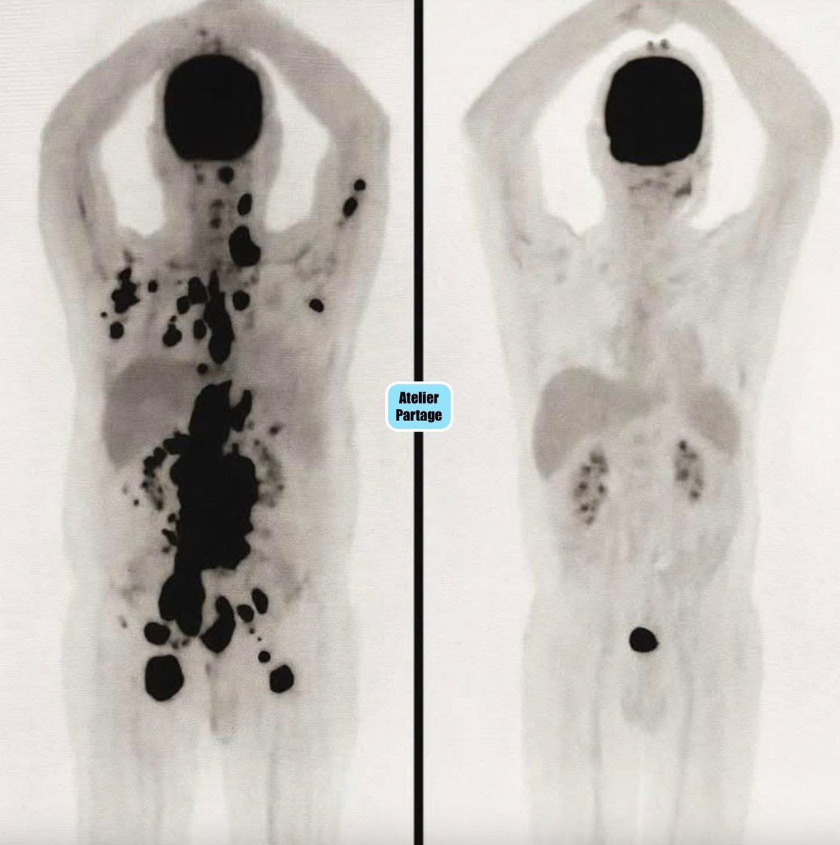 « Une percée prometteuse qui pourrait redéfinir la lutte contre le cancer.

En Corée du Sud, une équipe de chercheurs du KAIST (Korea Advanced Institute of Science and Technology) a mis au point une technologie qui ne vise pas à détruire les cellules cancéreuses… mais à les