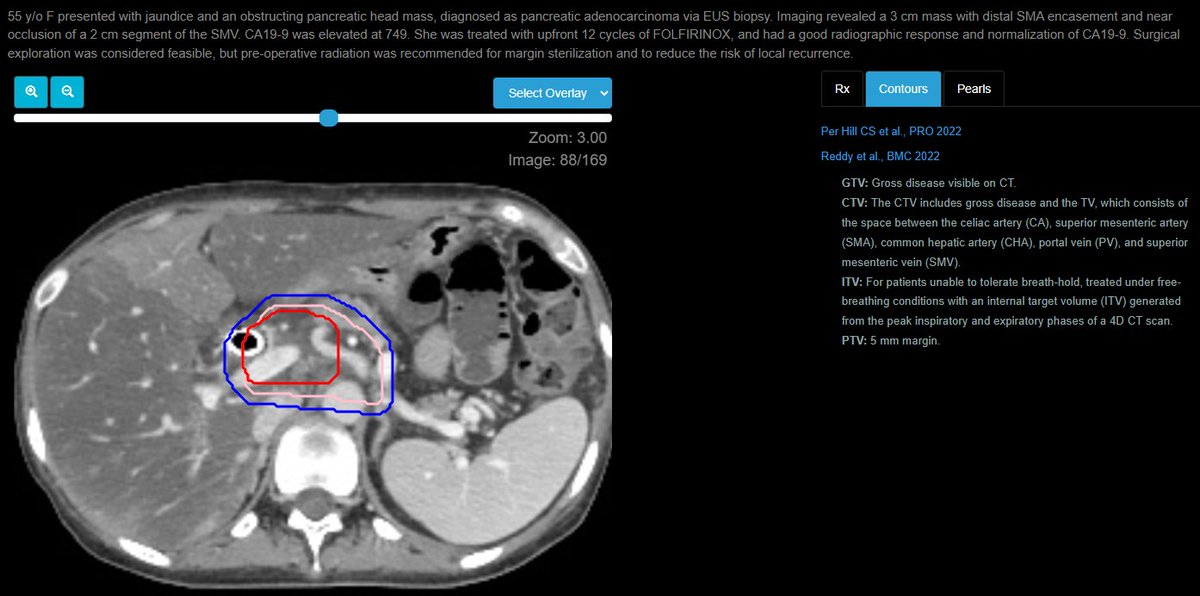 eContourRadOnc's tweet image. Review your pancreas &quot;Triangle Volume&quot; with this great case, submitted by Serena Moa, MD, PhD from @JohnsHopkins w/ special shout-out to @MikeChuongMD for reviewing!

PS: don&apos;t forget to check out the dose constraints for this SBRT case!

econtour.org/cases/168