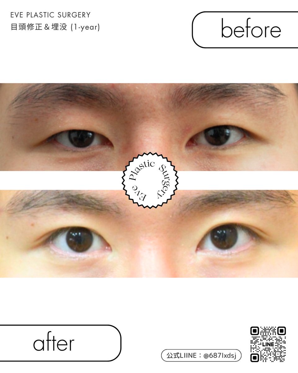 EvePlastic's tweet photo. 【イブ目頭修正・埋没：1年後の経過✨】

間違った手術からの修正手術から1年。
男性患者様の自然な変化をご紹介します🌿

目頭修正で、目と目のバランスが自然で整った印象に💫
埋没で、しっかりとした男らしさを
キープしながら自然な二重に。

傷跡もほとんど目立たず、
まるで“もともとの目”のような自然さ。

イブ整形外科では、
他院修正や再再手術にも対応しております。
カウンセリングからチョン先生が直接ご案内いたしますので、
お悩みの方はぜひ一度ご相談ください😊

📩公式LINE： https://t.co/EM8Gp4pptO

#目頭切開修正 #前切開修正 #前切開復元術 #他院修正
#再手術 #韓国整形 #イブ整形外科 #ナチュラル整形
#目元整形 #修正手術 #韓国美容クリニック #整形経過
#埋没 #埋没法 #整形考え中 #オーダーメイド整形
#メンズ整形 #男性美容整形 #韓国美容整形