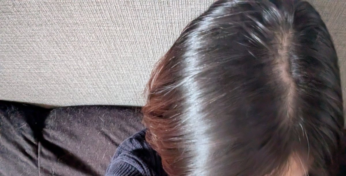 cando_for's tweet photo. ディナゲスト（ジエノゲスト）を飲み始めて1年ちょっと。
かなり薄毛になってしまいました😭
どなたか更年期や閉経後の薄毛対策、ご存知ないですか？？ https://t.co/7mepk2CtCy