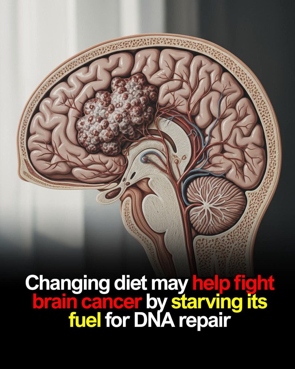 ShiningScience's tweet photo. Glioblastoma, the most aggressive form of brain cancer, is notoriously hard to treat because its cells adapt quickly and repair the DNA damage caused by chemoradiation. But a new study shows that changing diet may expose a hidden weakness in the tumor. Scientists discovered that while healthy brain cells use glucose for vital functions like nerve signaling, glioblastoma cells hijack it to churn out nucleotides, the raw materials needed to copy DNA and keep dividing. This constant supply helps the tumor bounce back from therapy.

The twist came when researchers noticed that glioblastoma cells also rely on an amino acid called serine, which they steal from nearby tissues. By putting mice with human tumor cells on a special diet very low in serine, scientists forced the cancer cells to redirect glucose into making serine instead of nucleotides. That shift left the tumors with fewer building blocks for DNA repair, making chemoradiation far more effective. Mice that followed this regimen survived longer compared to those given standard treatment alone.