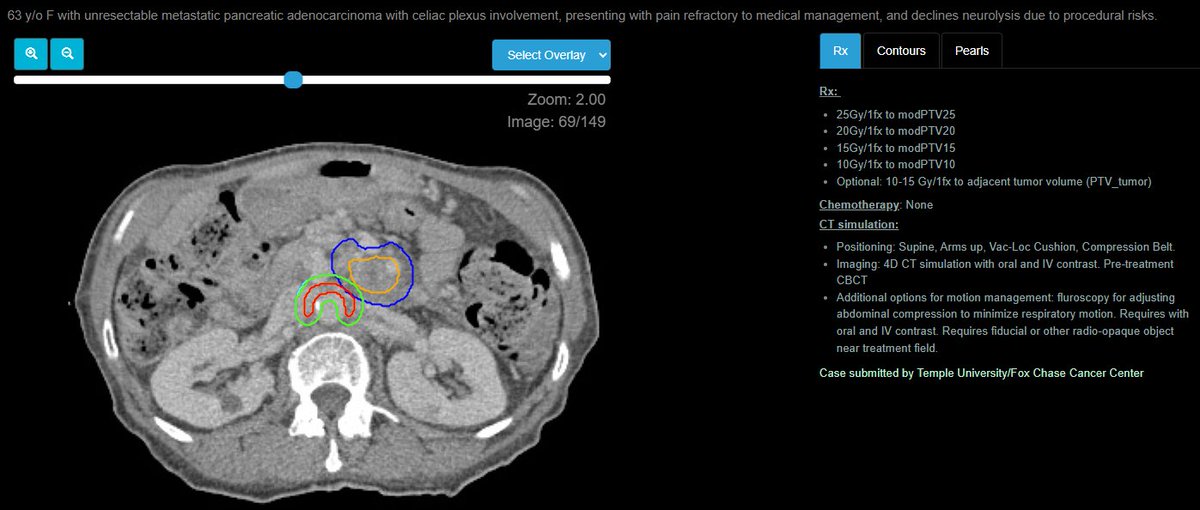 eContourRadOnc's tweet image. Celiac plexus ablation⚡️!

Never seen one? Check out how it&apos;s done and maybe suggest it next time for your pancreas patient with intractable pain!

econtour.org/cases/172

And you know it&apos;s good cuz @NiuSanford reviewed the case! Thanks Peter Lee, MD @FoxChaseCancer for the case