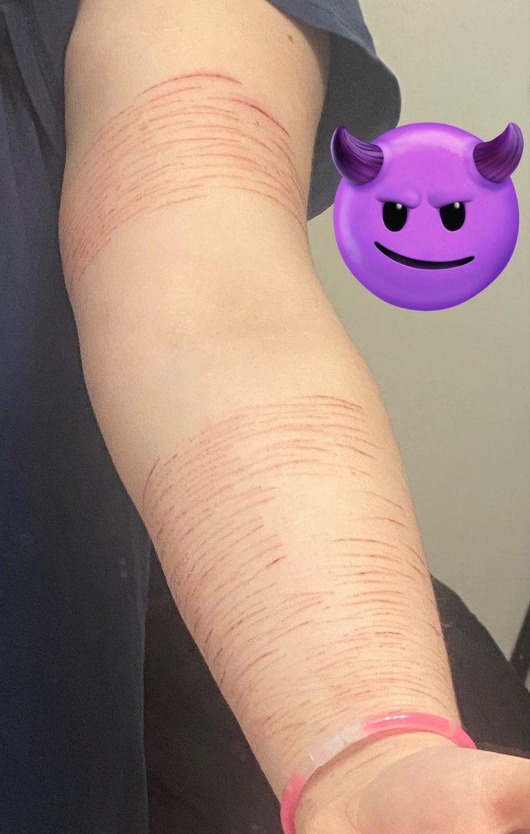 Vamp_9i's tweet photo. The cuts on my arm are healing and itch so baddddffd but they look good so it’s whatever 
#shtwt https://t.co/mc3ZjBBlMn