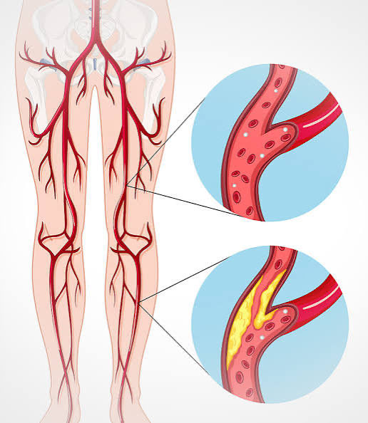 BraVascmed's tweet photo. Aqui na @BraVascmed tratamento e cuidados às DOENÇAS ARTERIAIS  : Doenças arteriais são condições que afetam as artérias, vasos que levam sangue oxigenado do coração para o resto do corpo, podendo causar seu estreitamento, bloqueio ou dilatação.saiba mais https://t.co/mTmuvf4vda https://t.co/5VzQze2jbs