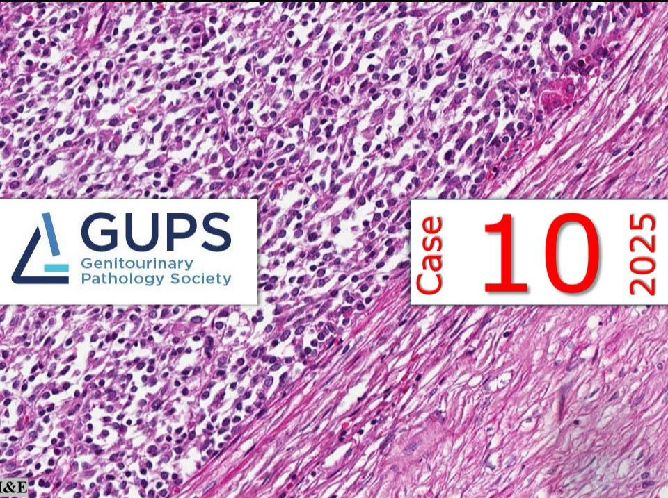 ** Case of the Month**

Male in his 30s with history of persisting right flank pain
gupathsociety.org/interesting-ca…

Send your cases to gupathsociety.org/submit-an-inte… 

FB: GU Pathology Society 
IG: gu_pathology_society
LinkedIN: GUPS Society
Bluesky: gupathsociety.bsky.social