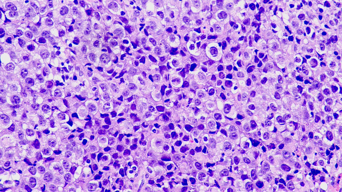 SumantaDas_7's tweet image. Tumor cells beneath the squamous mucosa with sheets of round to polygonal cells and abundant eosinophilic to clear cytoplasm, prominent nucleoli. Intermixed inflammatory cells. Carcinoma ? Melanoma ? Sarcoma ? Lymphoma ?