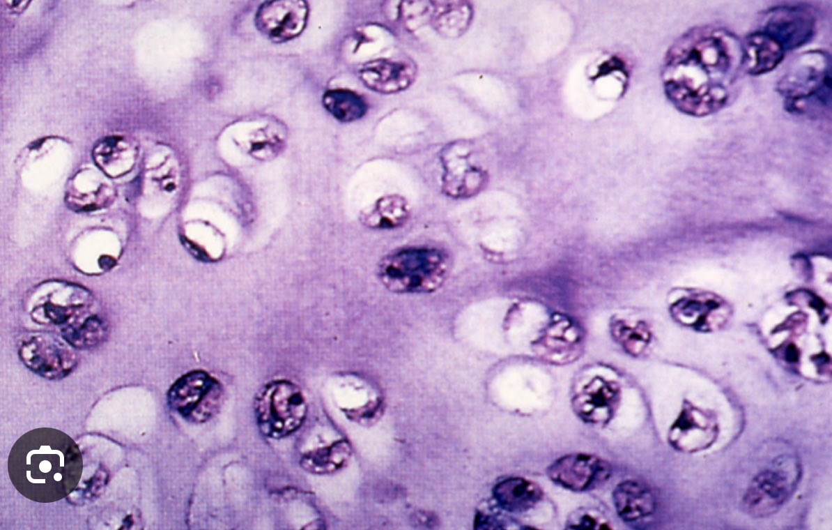 Death receptor 5 agonist ozekibart (INBRX-109) doubles PFS in pts with advanced or metastatic, IDH-mutated or -wildtype chondrosarcoma when compared to placebo, and delays deterioration in pain and other PROs. Read INHIBRx press release and Subbiah et al. Clin Cancer Res 2023
