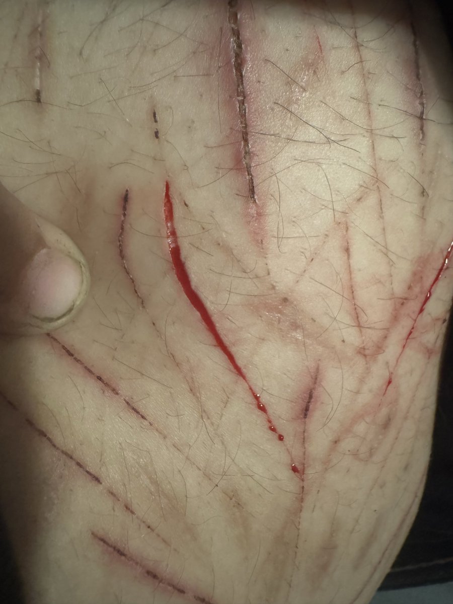 notsoviolent_'s tweet photo. TW CUTS
#shtwt #styro https://t.co/Zs3UJdIK2Q