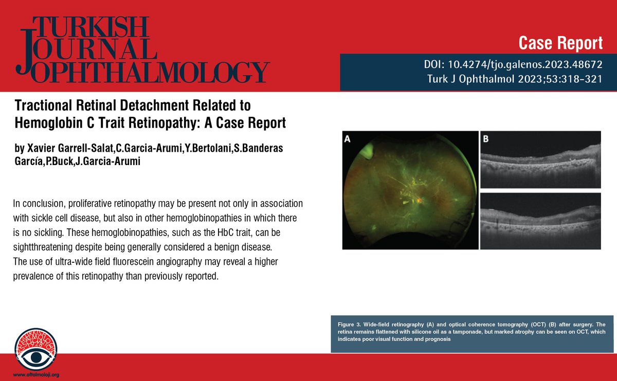 TurkJOphthalmol's tweet image. Tractional Retinal Detachment Related to Hemoglobin C Trait Retinopathy: A Case Report
You can see the free full text of the research by Xavier Garrell-Salat et al.
Link: oftalmoloji.org/articles/tract…
#HemoglobinCtrait #sicklecellretinopathy #retinaldetachment