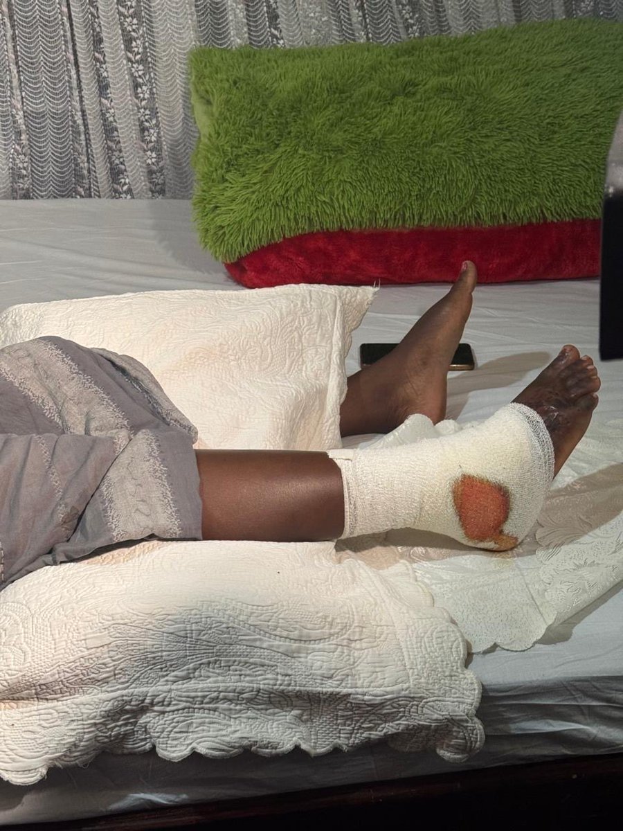VOCALAfrica_'s tweet image. Linet Achieng’, a 36-year-old mother of four, was injured on her right leg during the tragic stampede at Kasarani Stadium while viewing the body of the late Hon. Raila Odinga. 
The chaos began shortly after police opened fire.
She is now in need of financial assistance to help…