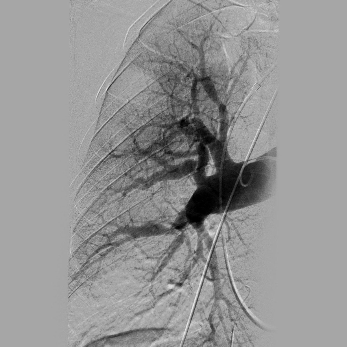 bartamas's tweet photo. 44F, 15 years ago (!) lost guidewire during ICU admission. Now CTEPH was diagnosed. 
PVR: 1018 dynes*sec*cm-5
PA: 110/29/55 Hgmm (S/D/M), SO2: 67% https://t.co/i2r9wF2Qty