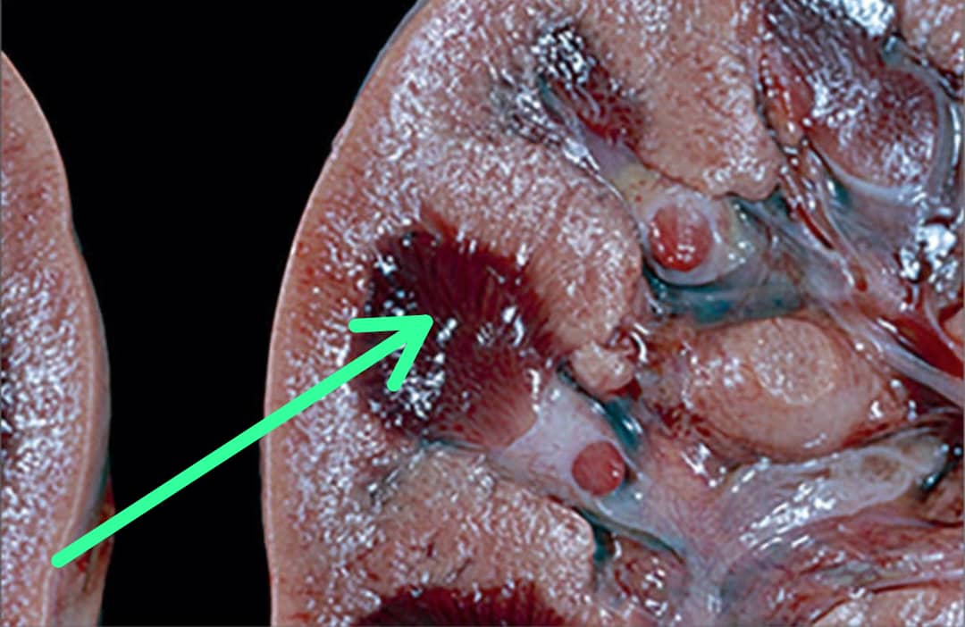 🚨This is what severe dehydration can cause: Acute Kidney Injuries (AKI).  

Please stop what you are doing and take some water.