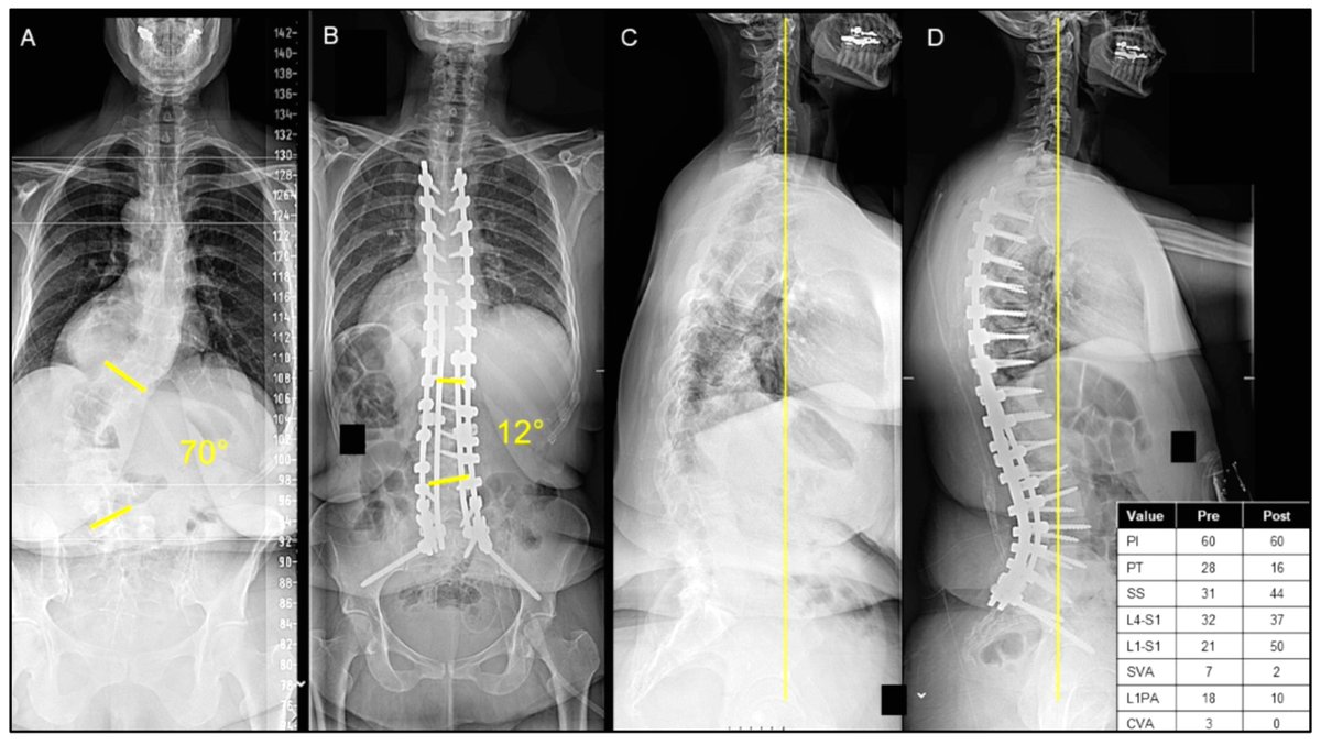 #mdpijcm
#OpenAccess 
✨Call for Reading
Who Can Be Discharged Home after #AdultSpinalDeformitySurgery?
🎯mdpi.com/2693352
✍️<a href="/ScottZuck/">Scott Zuckerman, MD, MPH</a> <a href="/HaniChanbour/">Hani Chanbour MD</a>   
🏬<a href="/VUMCDiscoveries/">Vanderbilt University Medical Center</a>  <a href="/VanderbiltU/">Vanderbilt University</a>
<a href="/MediPharma_MDPI/">MDPI Medicine & Pharmacology</a>