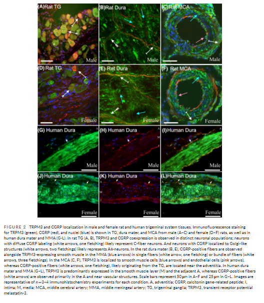 HeadacheJournal's tweet image. Open Access:
Activating #TRPM3 triggers #CGRP release in #trigeminal neurons, linking an ion channel to #migraine pathways
🧠 This discovery hints at therapeutic targets &amp;amp; could help develop new migraine treatments
@spy_kaz @ConnarWestgate
Read more 👉…adachejournal.onlinelibrary.wiley.com/share/J64GDVXE…
