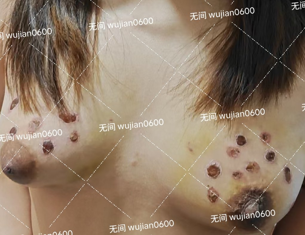 烟疤逐渐变多。#烟疤 #烟烫 #灭烟 #烟灰缸 #疼痛 #sm #男s女m #男主女奴 #恋痛 #男s #女奴 #邢奴 #虐待 #胸灭烟