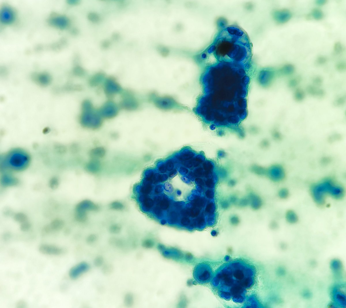 padmapathology1's tweet image. Older ♀️ with pleural effusion.
#PathTwitter #pathology #cytopath 
Acinar pattern